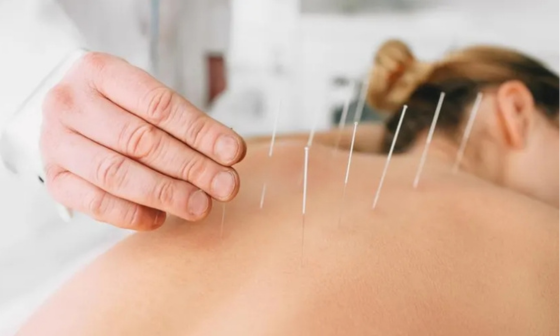 Acupuncture