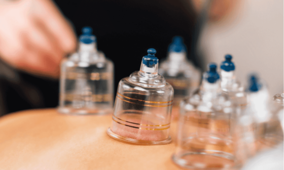 Cupping thérapie (Hijama)